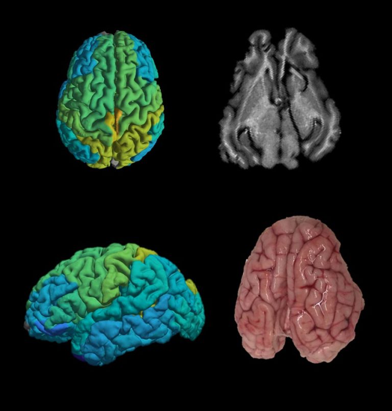 Hebrew U researchers develop MRI technique to detect molecular changes in brain