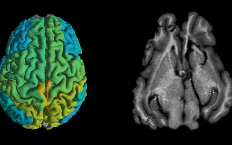 Brain under an MRI scanner