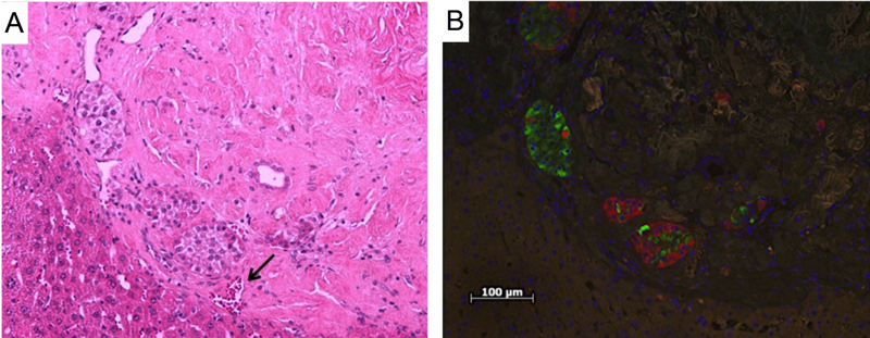 Histological analysis of explanted islet grafts 90 days post-transplantation: (A) Hematoxylin and eosin staining of a cross-section of an explanted EMP graft on the surface of the liver showing multiple islets with an erythrocyte filled blood vessels (arrow). (B) Immunohistochemistry staining of the same section confirming the presence of insulin (red) and glucagon (green).