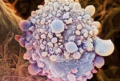 Colour enhanced, magnified view of a pancreatic cancer cell.
