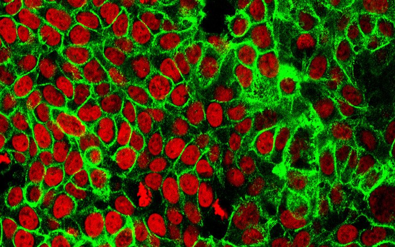This microscope image made available by the National Cancer Institute Center for Cancer Research shows human colon cancer cells with the nuclei stained red.