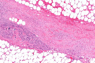 Microscope image of nectrotizing fasciitis - flesh-eating disease.