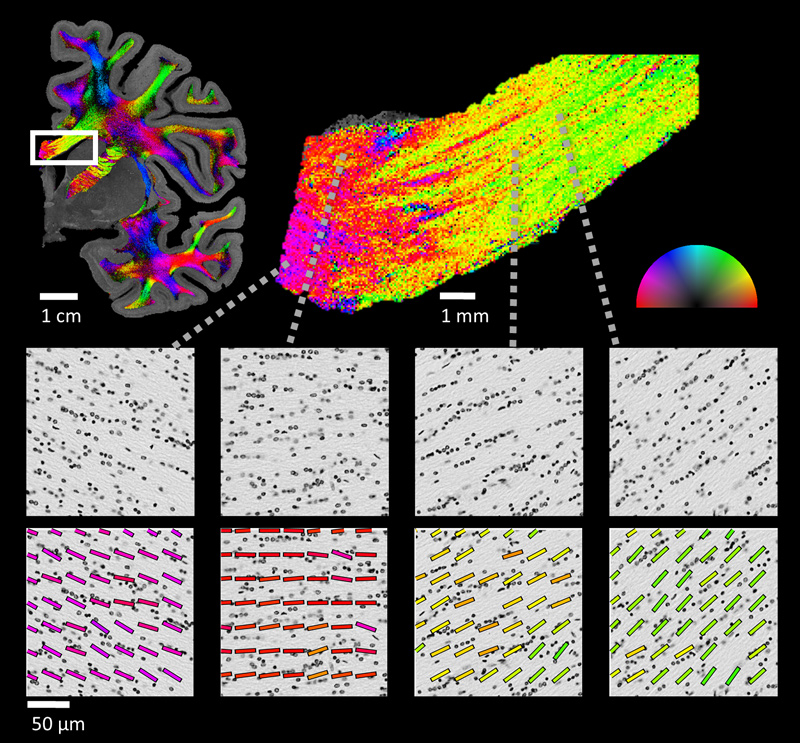 Nissl-based Structure Tensor Analysis of the human corpus callosum. (A) In-plane orientation maps in a coronal slice of the right hemisphere (in tiles of 2002 microns2, smoothing kernel of 15 microns), color-coded according to the semicircle on the right. The in-plane 10 orientation is calculated as the peak orientation of the structure tensors in each tile. (B) Magnified view of the corpus callosum (CC) region indicated in panel (a), calculated in 50×50 microns2 tiles. (C) Example tiles from different locations along the CC. Top: Glial cells are organized in short rows oriented along nearby axons. Bottom: A subset of the pixel-wise orientations overlaid on top of the grayscale tiles. (D) Polar histograms of the glial-rows orientation distribution functions 15 (gODF) in each tile.