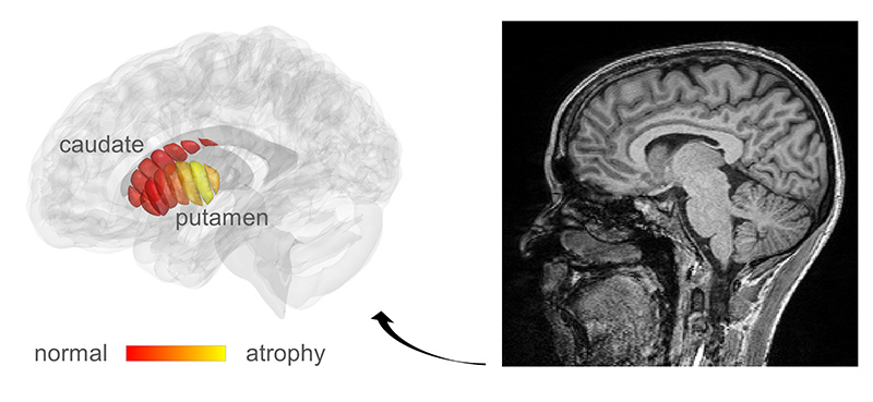 MRI images used for automatic detection of microstructural changes in early-stage Parkinson’s Disease (PD) patients. Marked in yellow are areas in the putamen where PD patients show tissue damage, compared to healthy controls