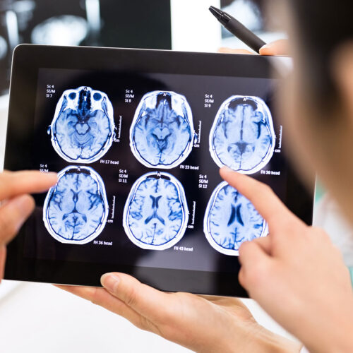 New MRI Tech from Hebrew U non-invasively tests iron for Brain Health