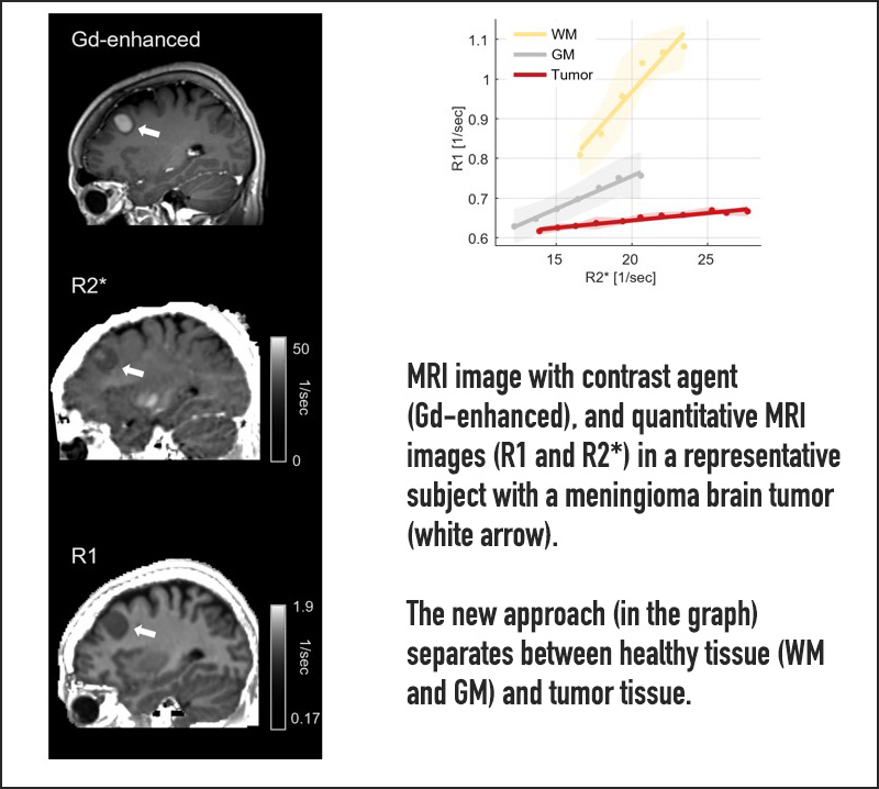 MRI image with contrast agent (Gd-enhanced), and quantitative MRI images (R1 and R2*) in a representative subject with a meningioma brain tumor (white arrow). Our new approach (in the bottom) separates between healthy tissue (WM and GM) and tumor tissue.